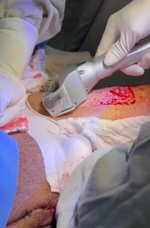 Dermatomo Neumático