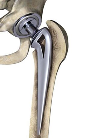 Endoprotesis articulares pediatrica