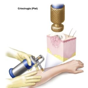 Equipor de Crioterapia
