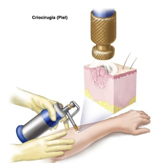 Equipor de Crioterapia